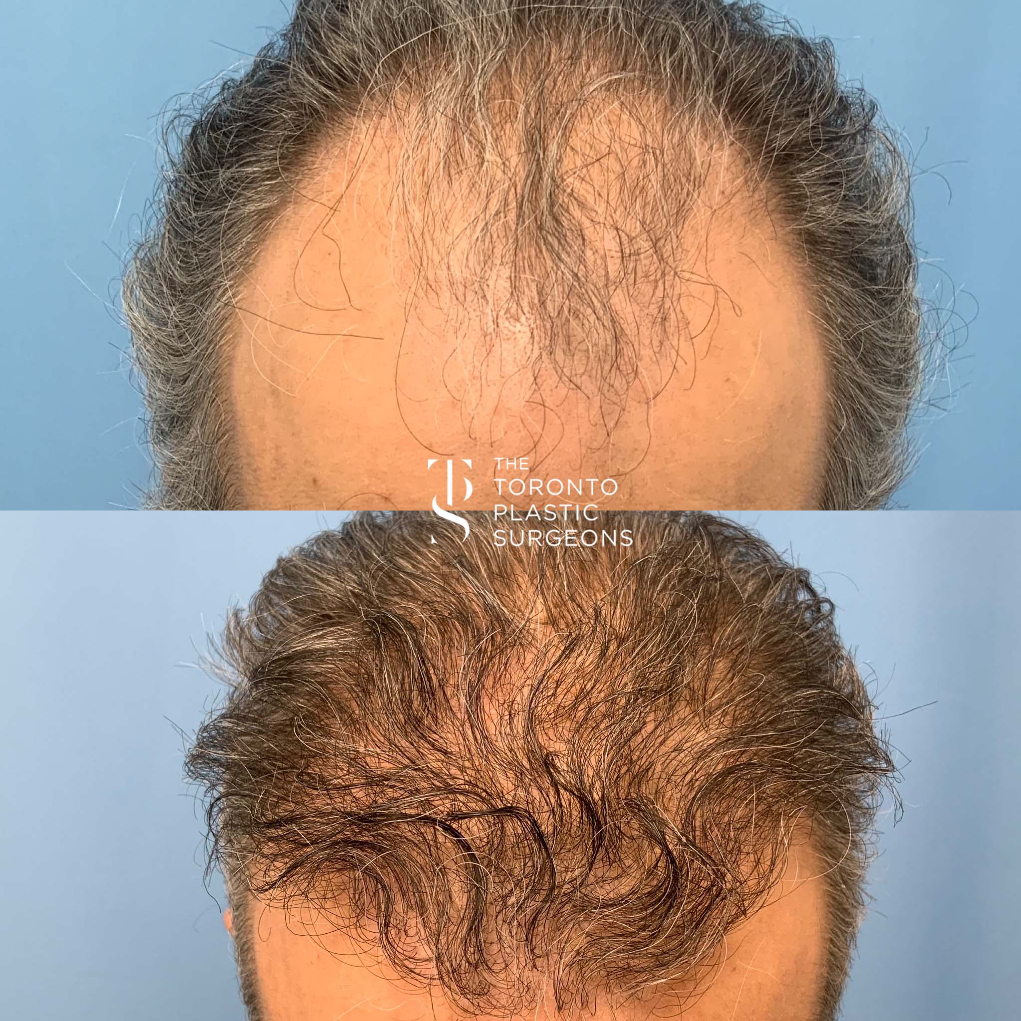 What Not To Do After a Hair Transplant | Surgery Group UK
