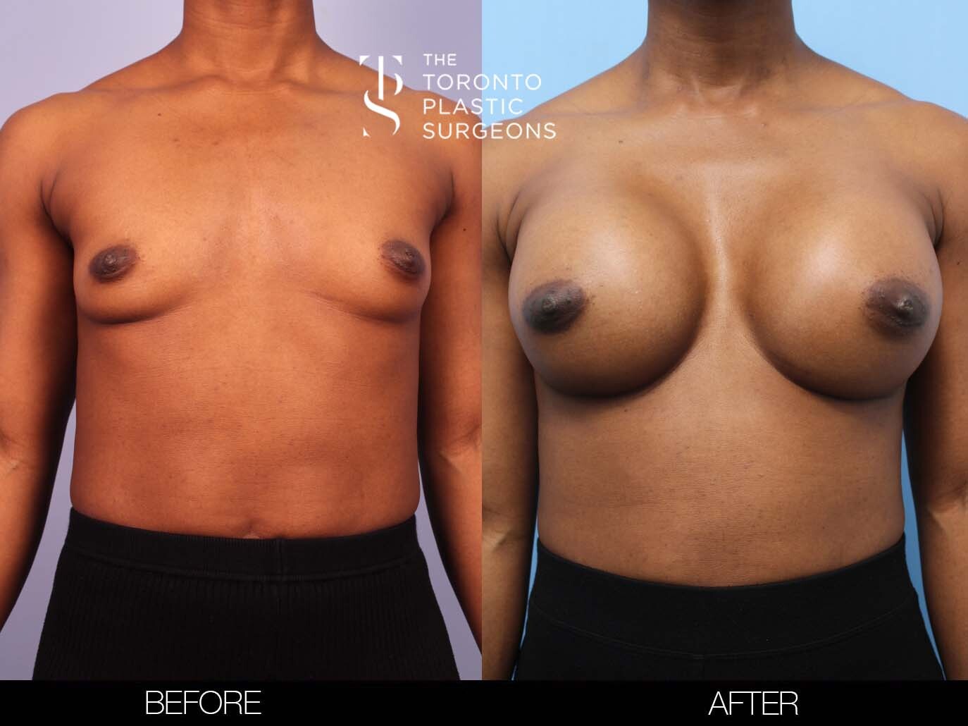 Before and after of breast implant surgery