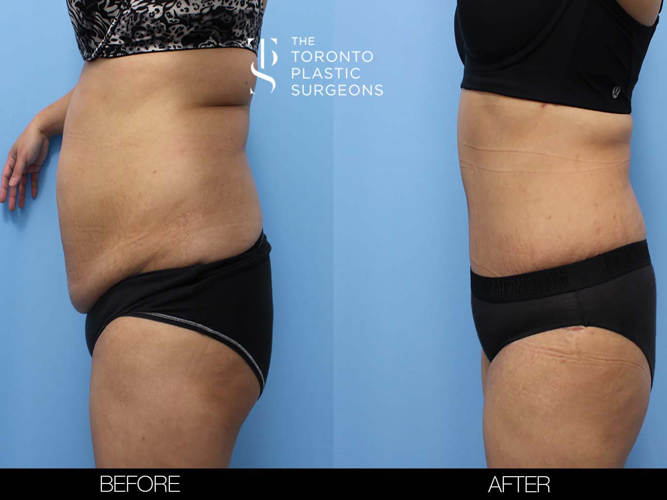 Compression Garments After a Tummy Tuck - Front Range Plastic Surgery