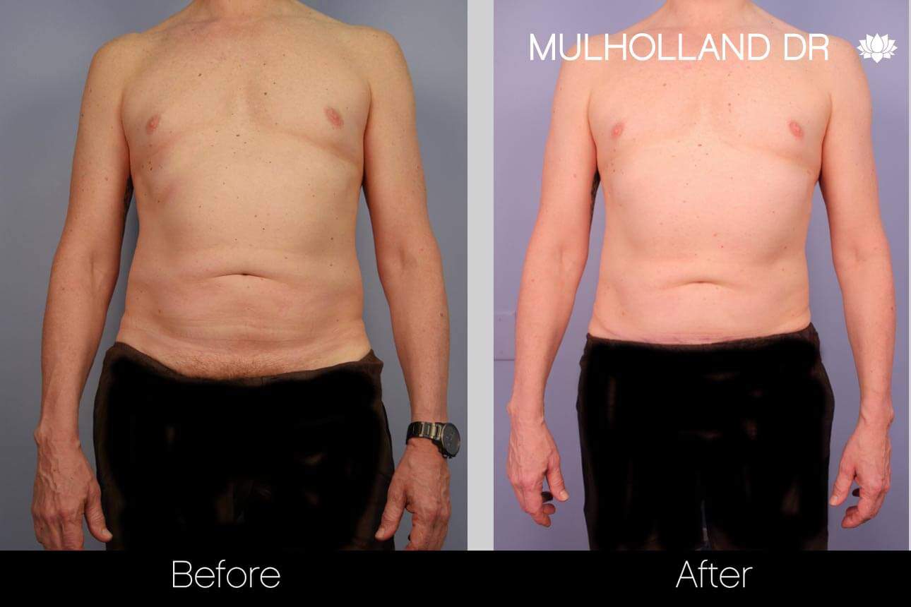 Abdomen Liposuction - Before and After Gallery - Patient Photo 1