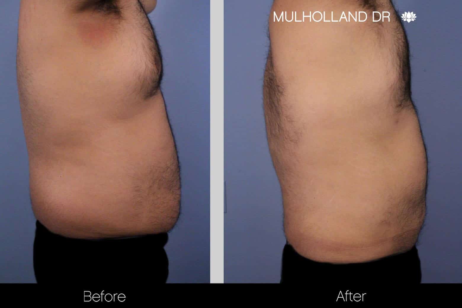 Abdomen Liposuction - Before and After Gallery - Patient Photo 10