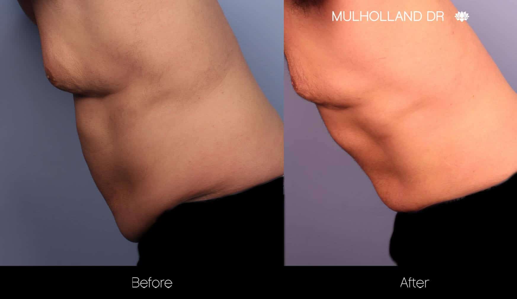 Abdomen Liposuction - Before and After Gallery - Patient Photo 12