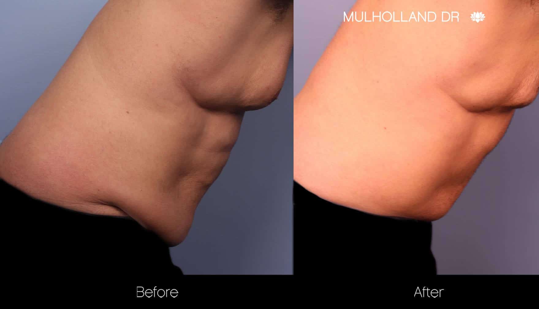 aAbdomen Liposuction - Before and After Gallery - Patient Photo 13