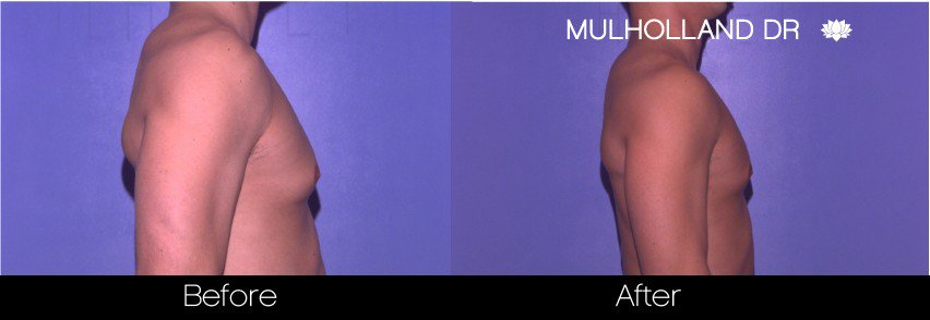 Abdomen Liposuction - Before and After Gallery - Patient Photo 14