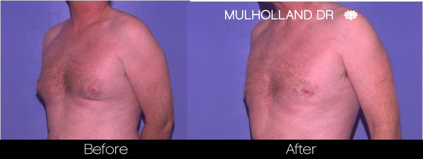Abdomen Liposuction - Before and After Gallery - Patient Photo 17