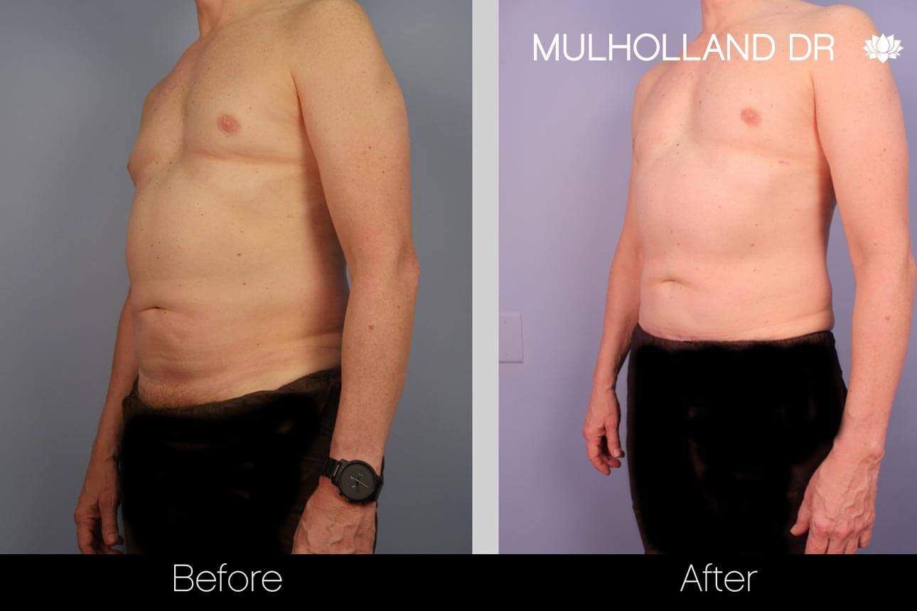 Abdomen Liposuction - Before and After Gallery - Patient Photo 2