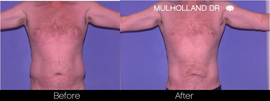 Abdomen Liposuction - Before and After Gallery - Patient Photo 21