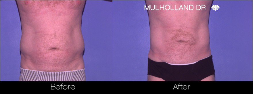 Abdomen Liposuction - Before and After Gallery - Patient Photo 22
