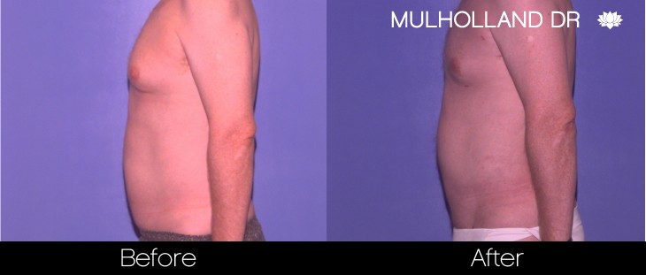 Abdomen Liposuction - Before and After Gallery - Patient Photo 23