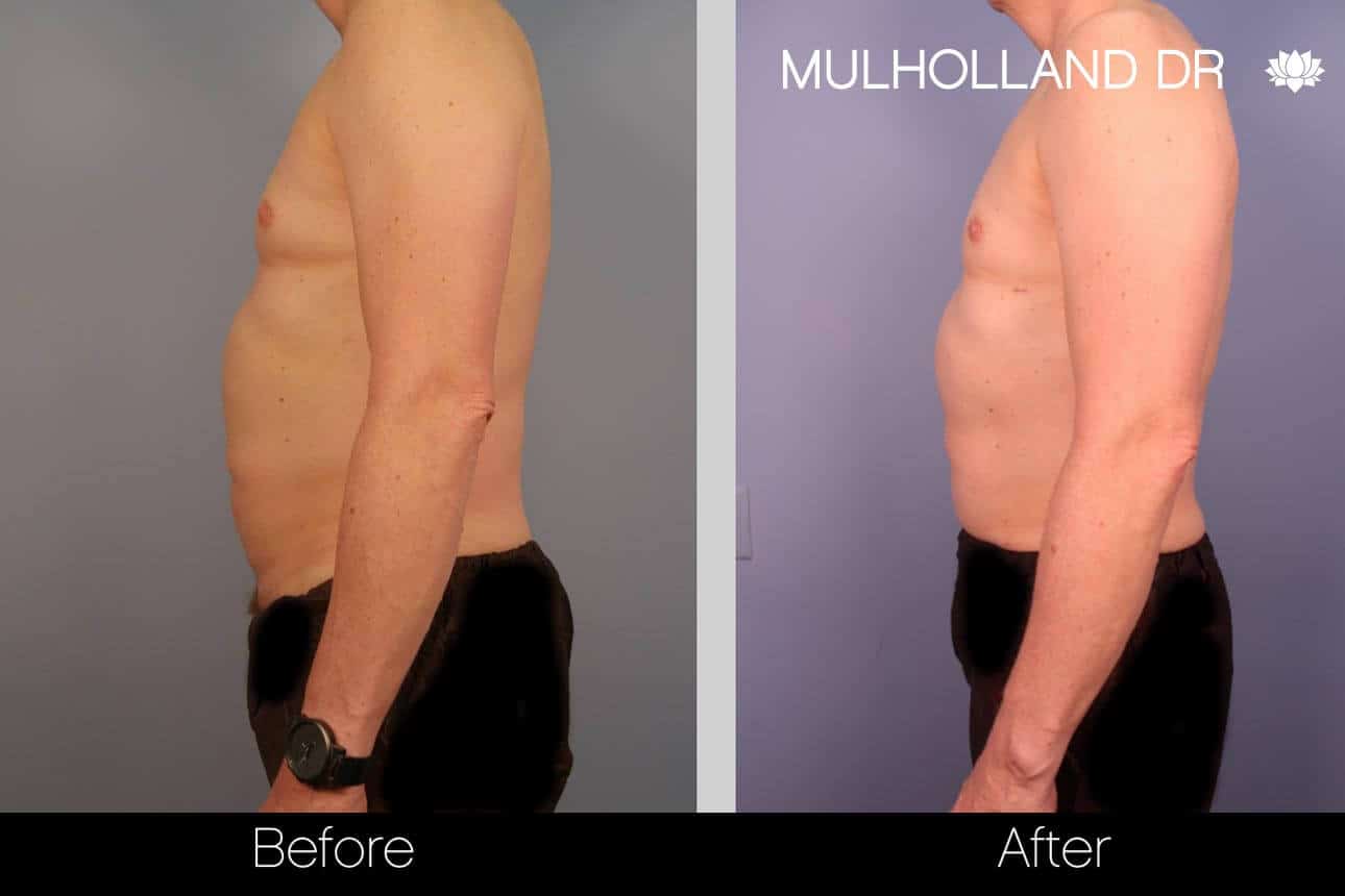 Abdomen Liposuction - Before and After Gallery - Patient Photo 3