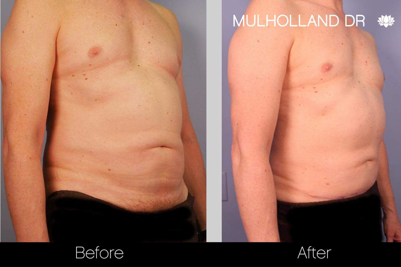 Abdomen Liposuction - Before and After Gallery - Patient Photo 4