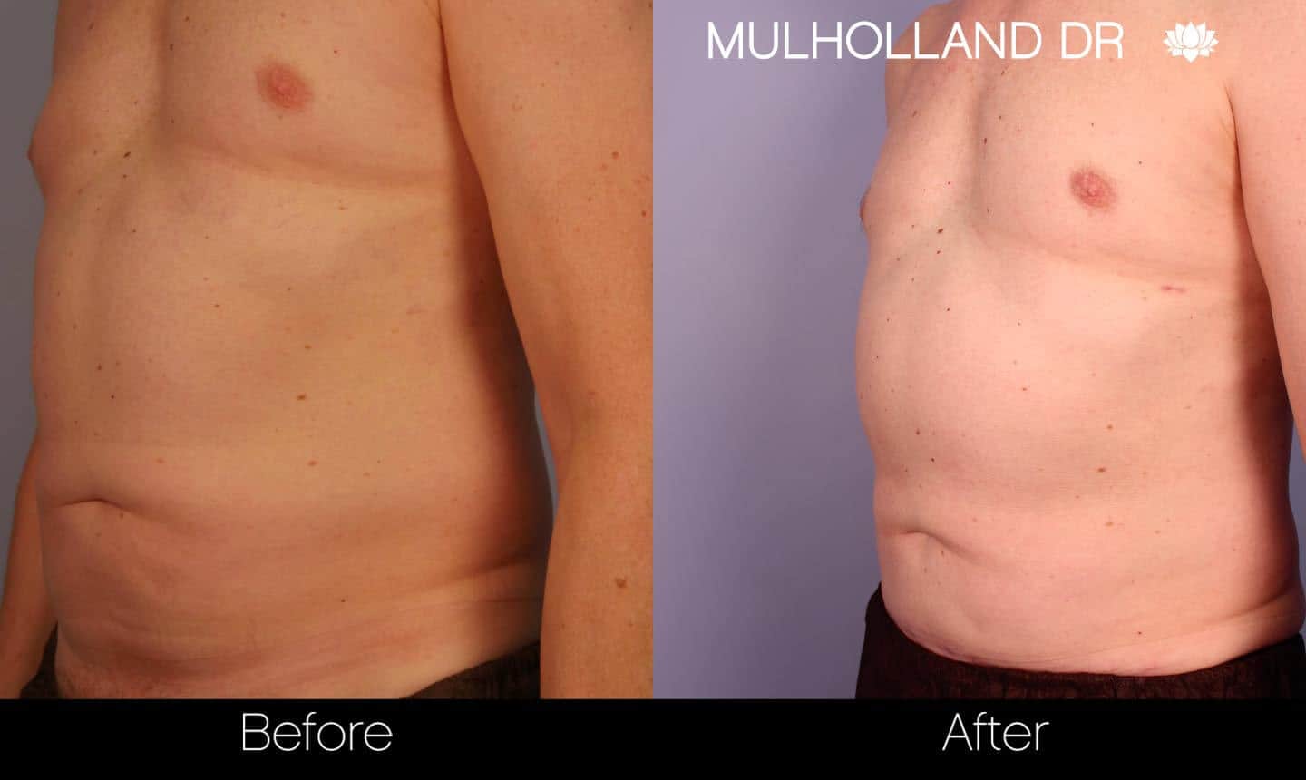 Abdomen Liposuction - Before and After Gallery - Patient Photo 5