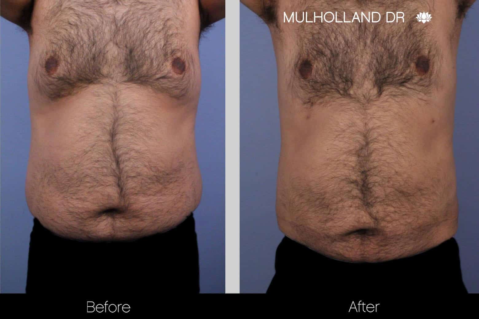 Abdomen Liposuction - Before and After Gallery - Patient Photo 6