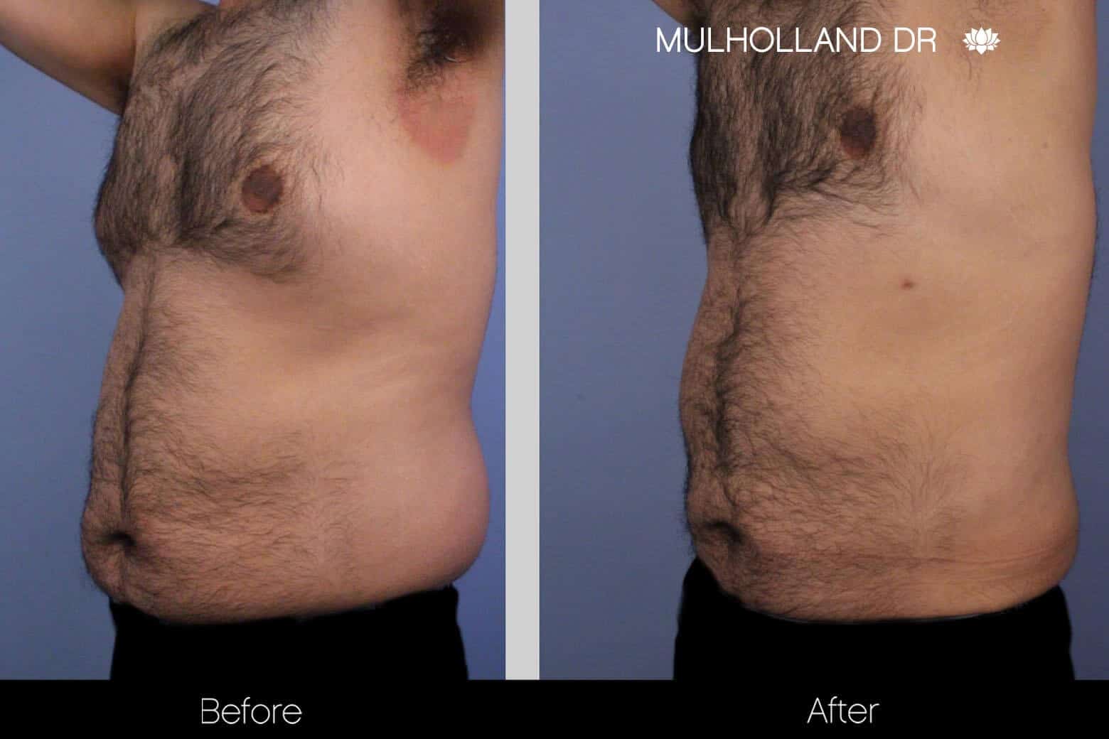 Abdomen Liposuction - Before and After Gallery - Patient Photo 7