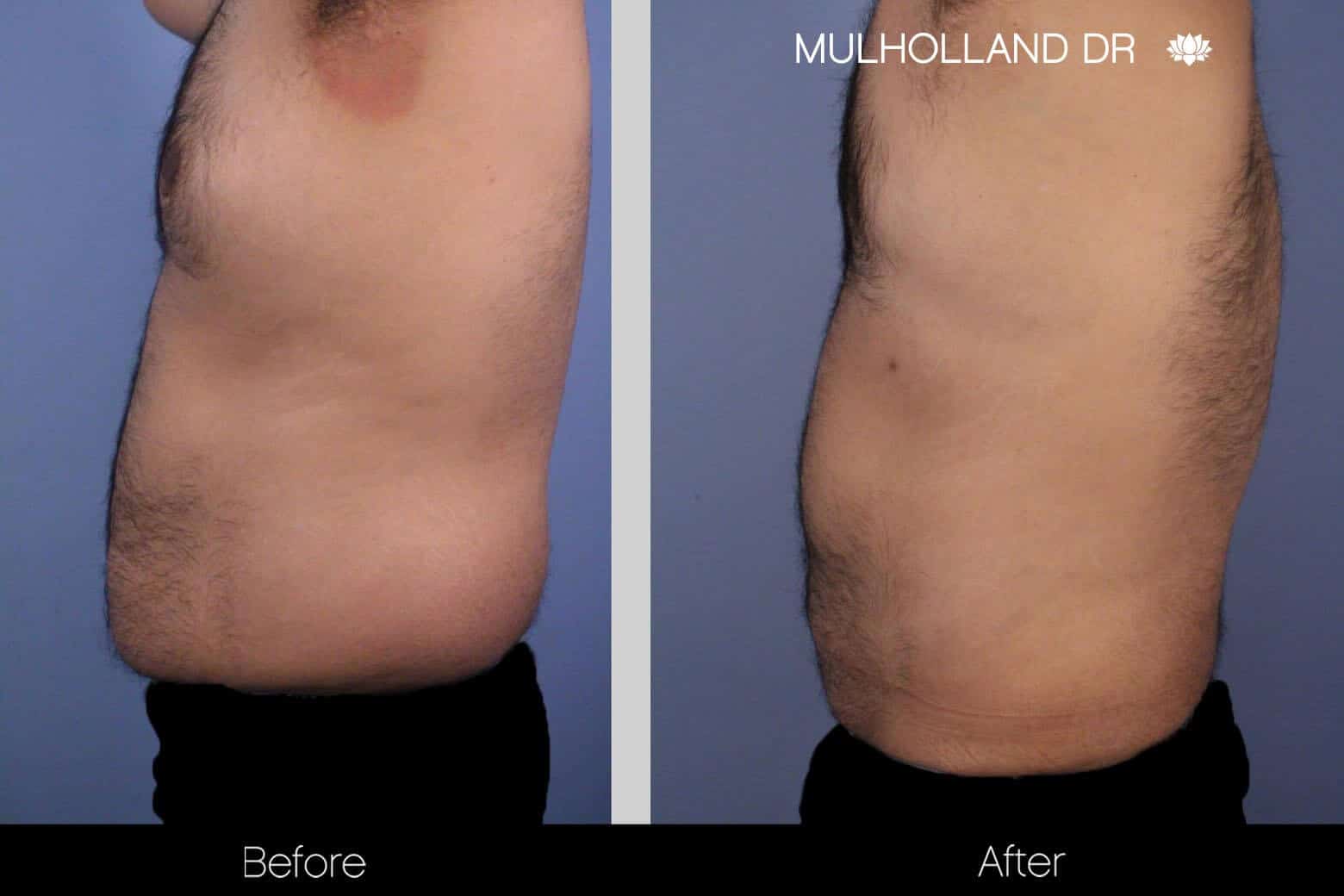 Abdomen Liposuction - Before and After Gallery - Patient Photo 8