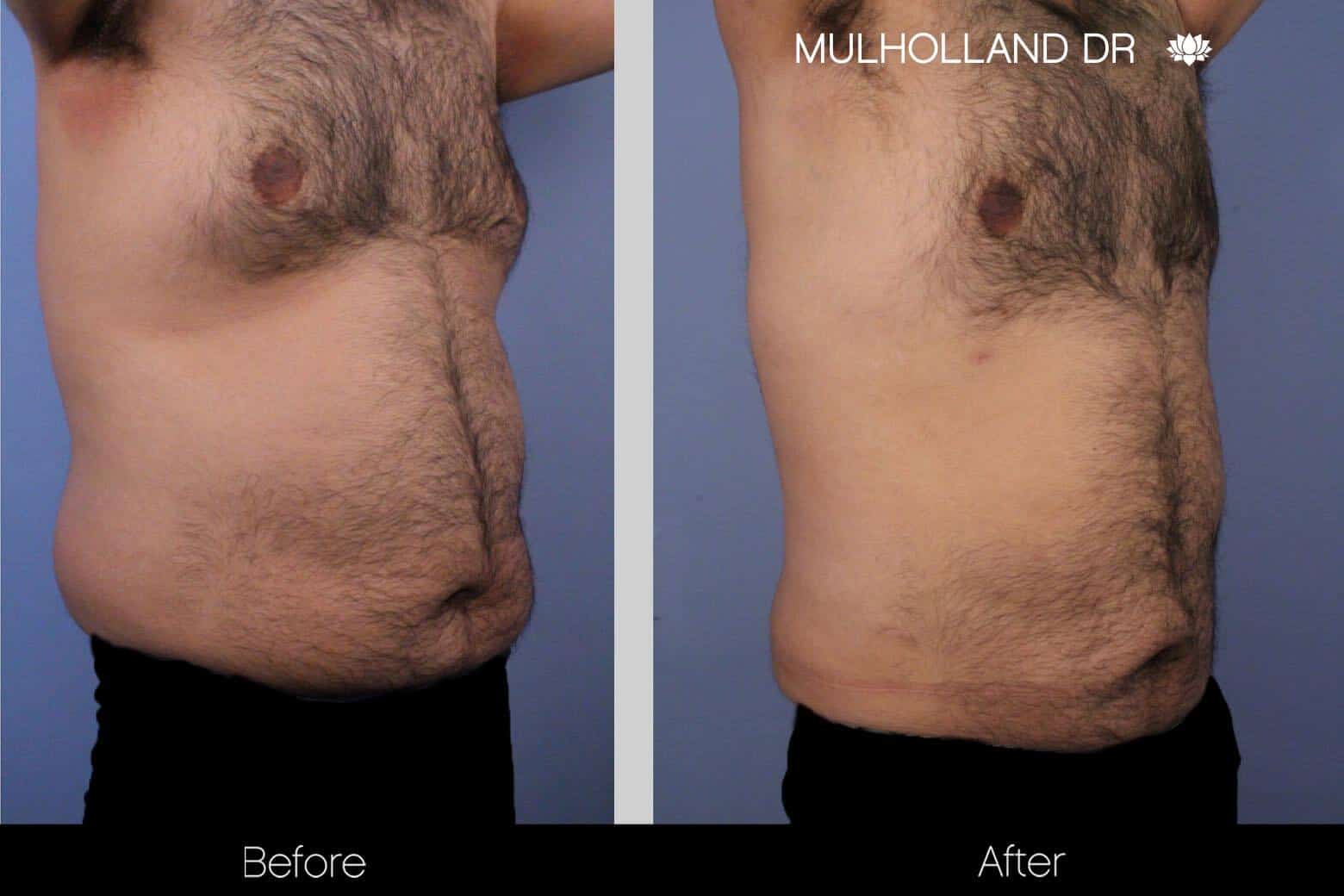 Abdomen Liposuction - Before and After Gallery - Patient Photo 9