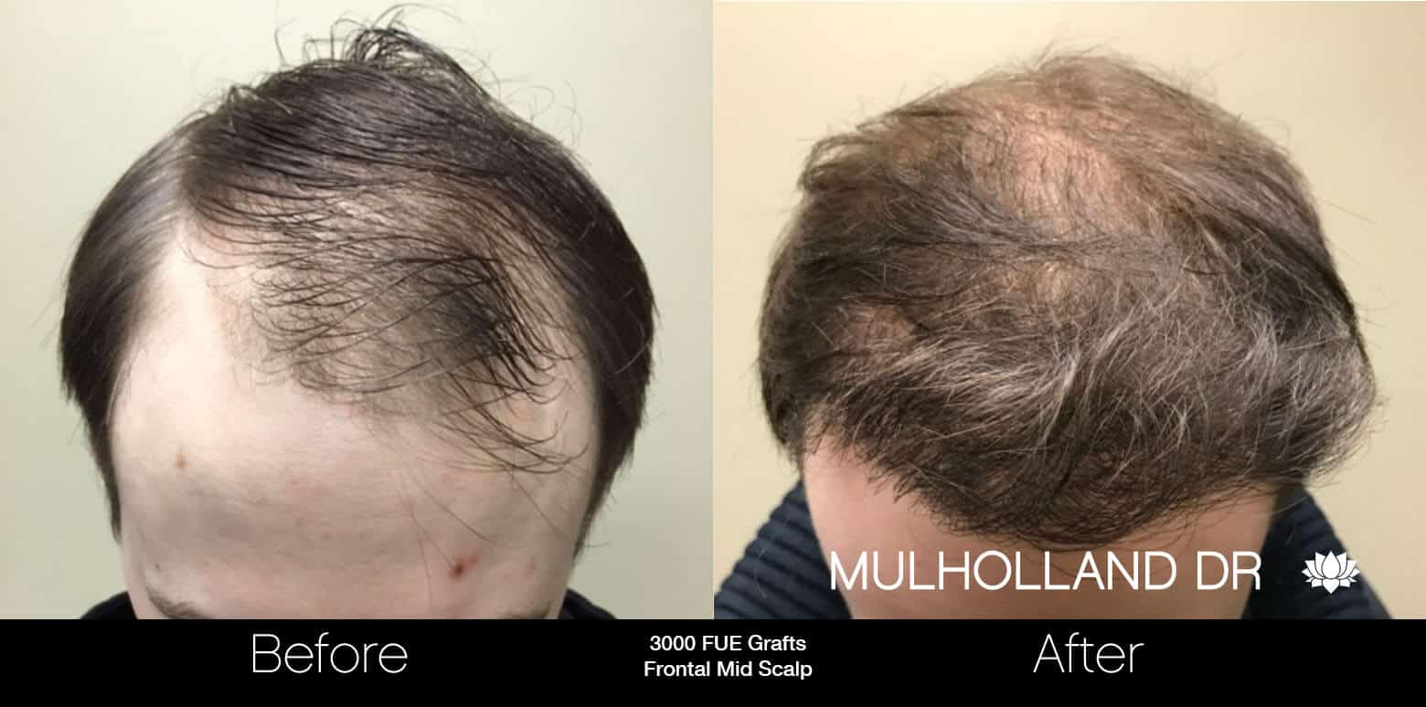 Artas Hair Transplant - Before and After Gallery - Patient Photo 1