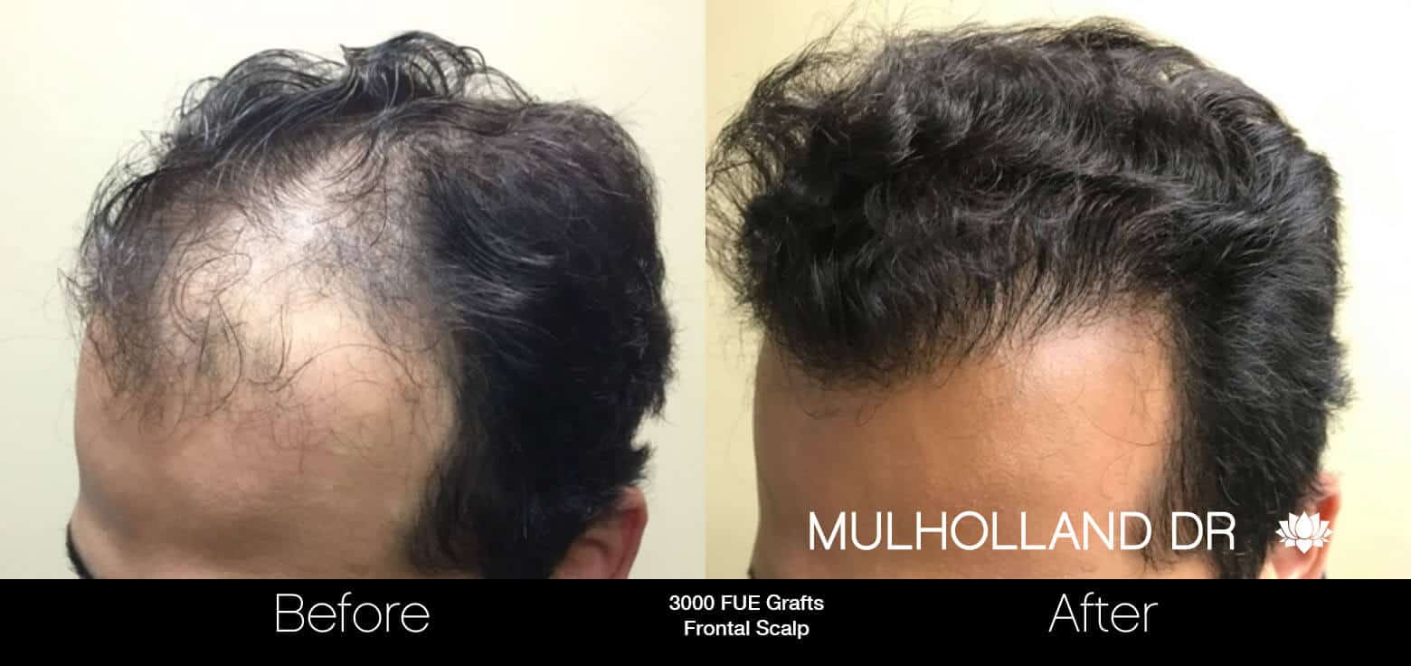 Artas Hair Transplant - Before and After Gallery - Patient Photo 10