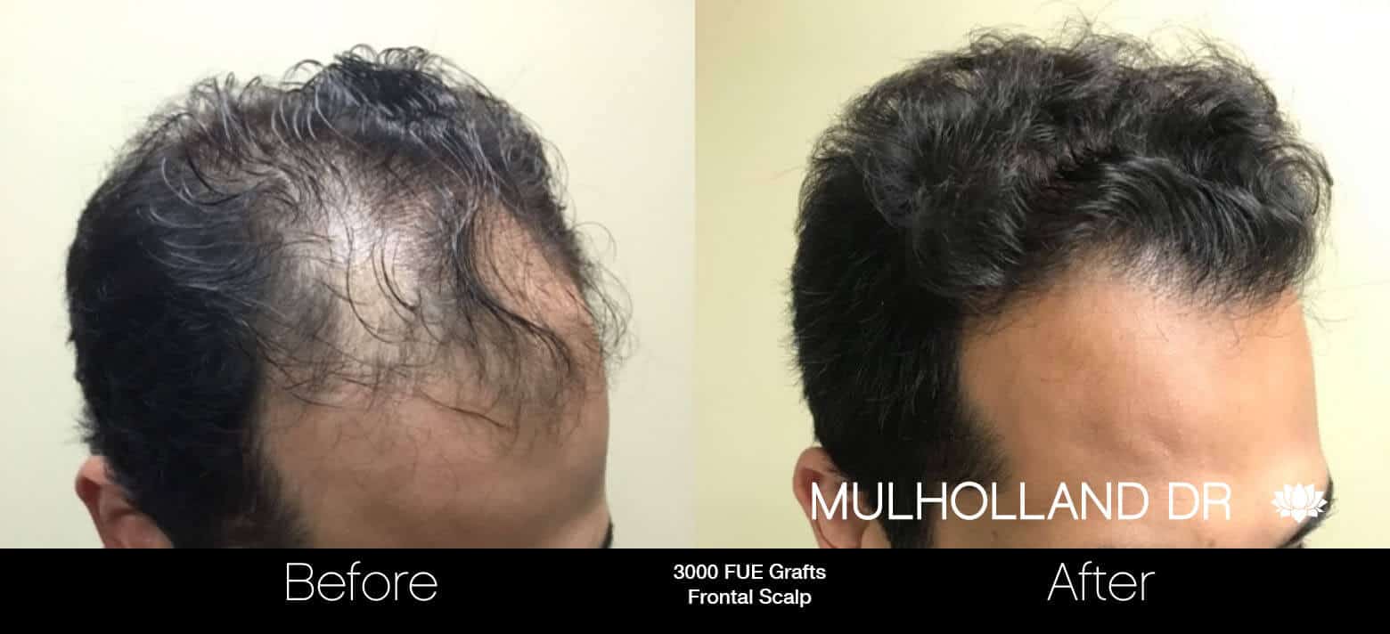 Artas Hair Transplant - Before and After Gallery - Patient Photo 11