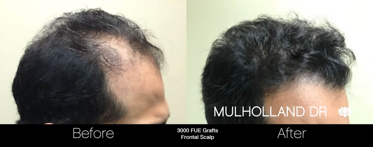 Artas Hair Transplant - Before and After Gallery - Patient Photo 13