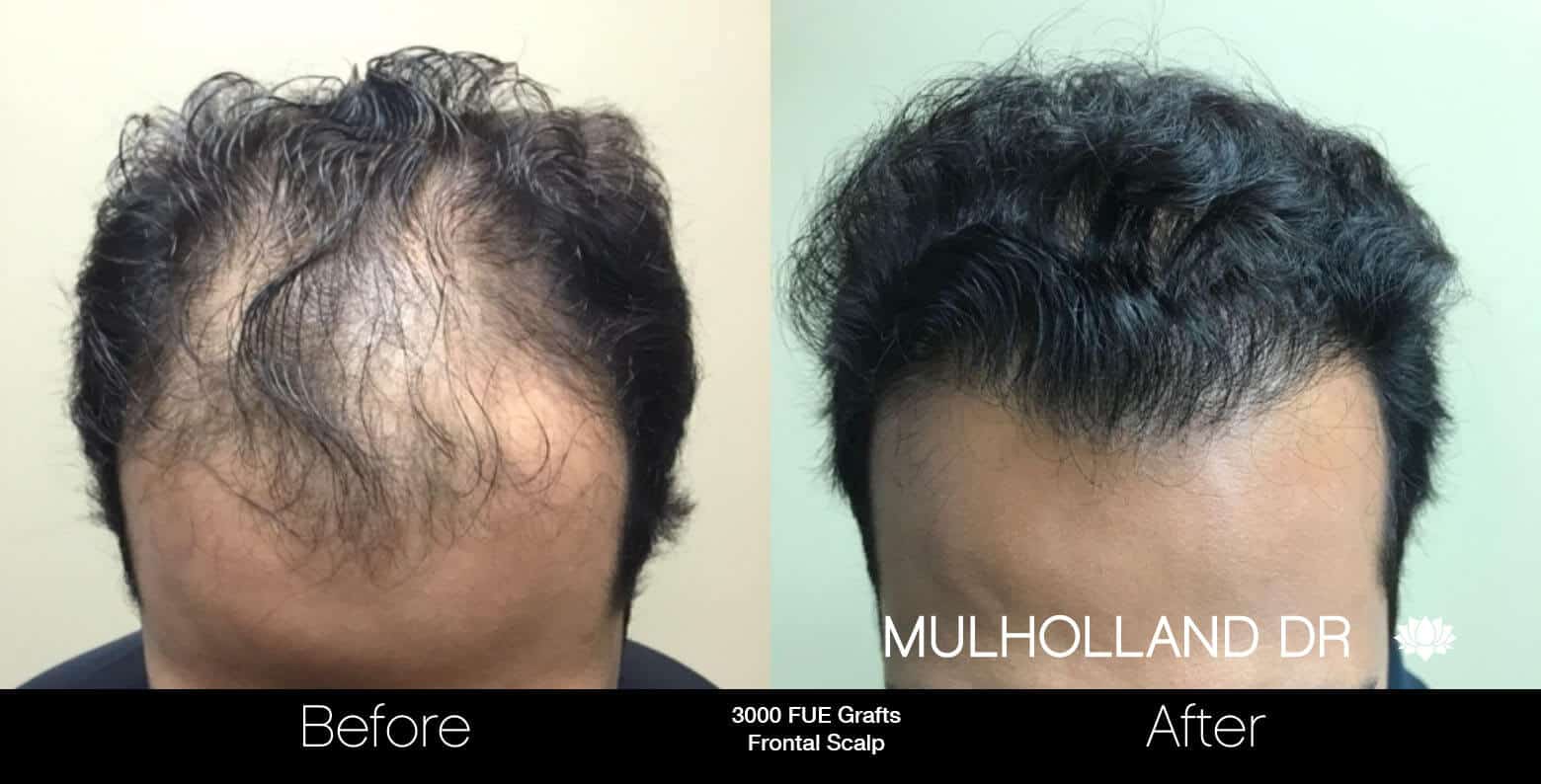 Artas Hair Transplant - Before and After Gallery - Patient Photo 14
