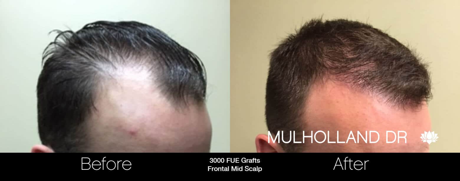 Artas Hair Transplant - Before and After Gallery - Patient Photo 16