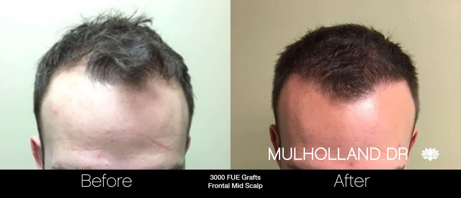 Artas Hair Transplant - Before and After Gallery - Patient Photo 17