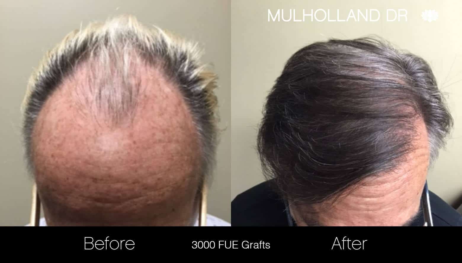 Artas Hair Transplant - Before and After Gallery - Patient Photo 18