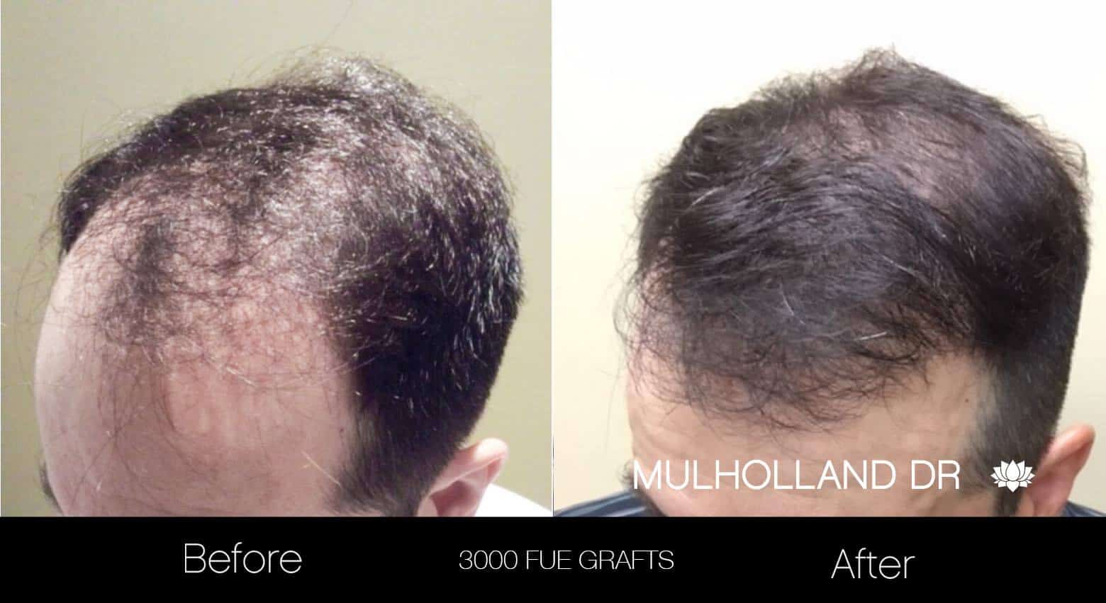 Artas Hair Transplant - Before and After Gallery - Patient Photo 19