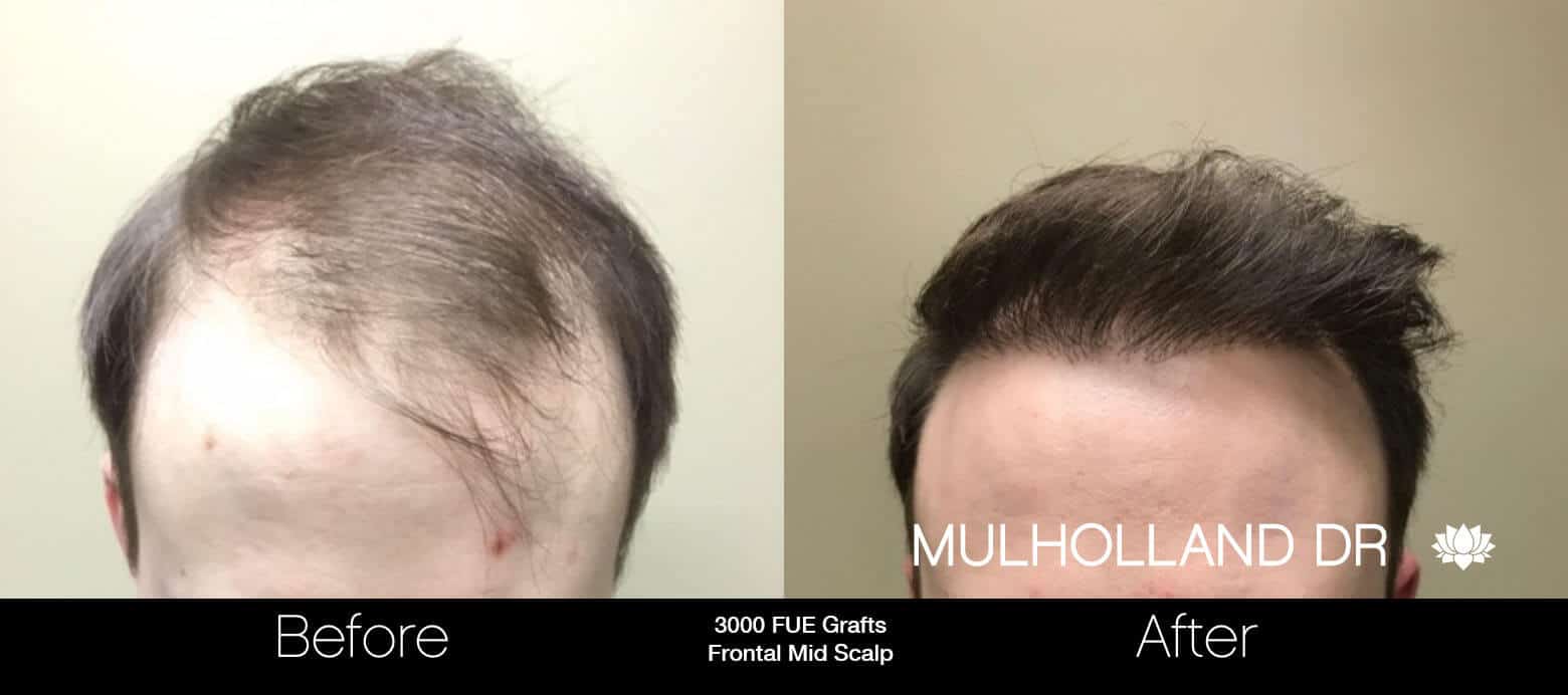 Artas Hair Transplant - Before and After Gallery - Patient Photo 2