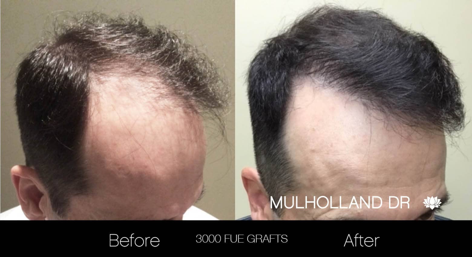 Artas Hair Transplant - Before and After Gallery - Patient Photo 20