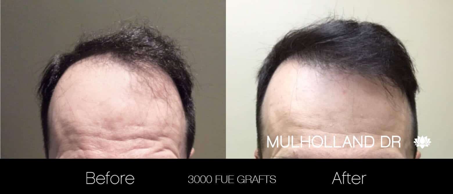 Artas Hair Transplant - Before and After Gallery - Patient Photo 21