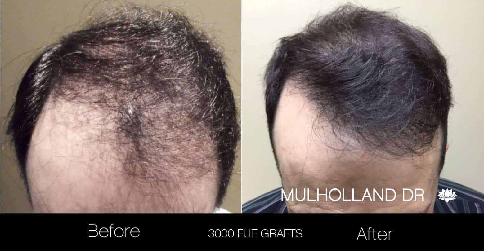 Artas Hair Transplant - Before and After Gallery - Patient Photo 22