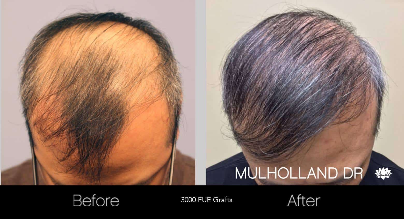 Artas Hair Transplant - Before and After Gallery - Patient Photo 23