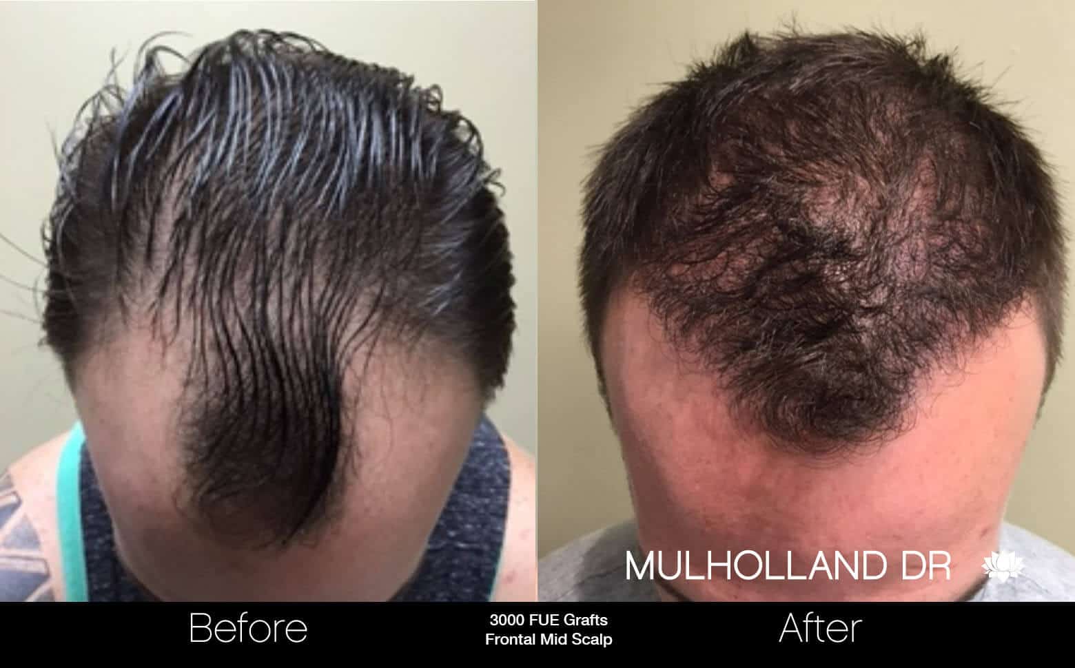 Artas Hair Transplant - Before and After Gallery - Patient Photo 24
