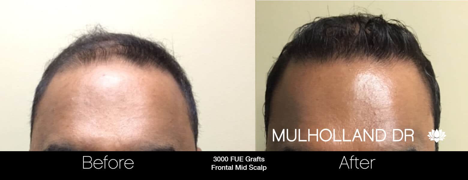 Artas Hair Transplant - Before and After Gallery - Patient Photo 25