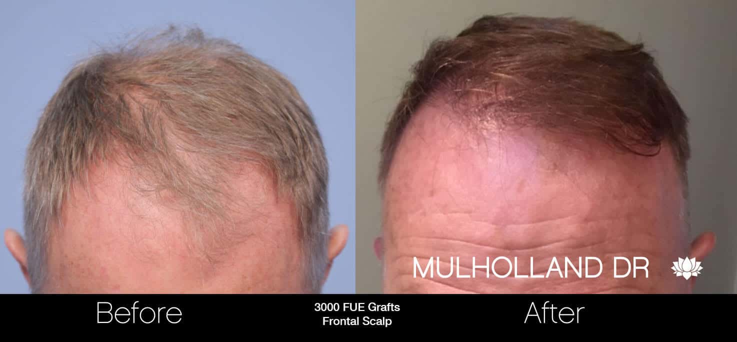 Artas Hair Transplant - Before and After Gallery - Patient Photo 27