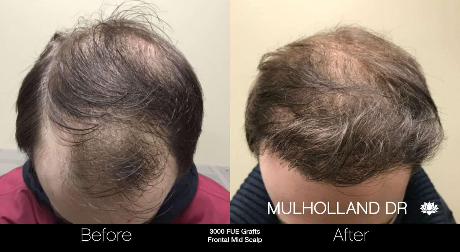 Artas Hair Transplant - Before and After Gallery - Patient Photo 28