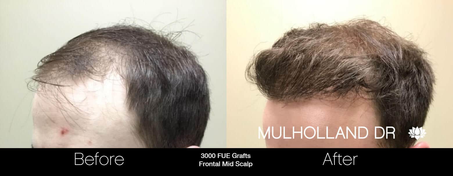 Artas Hair Transplant - Before and After Gallery - Patient Photo 3