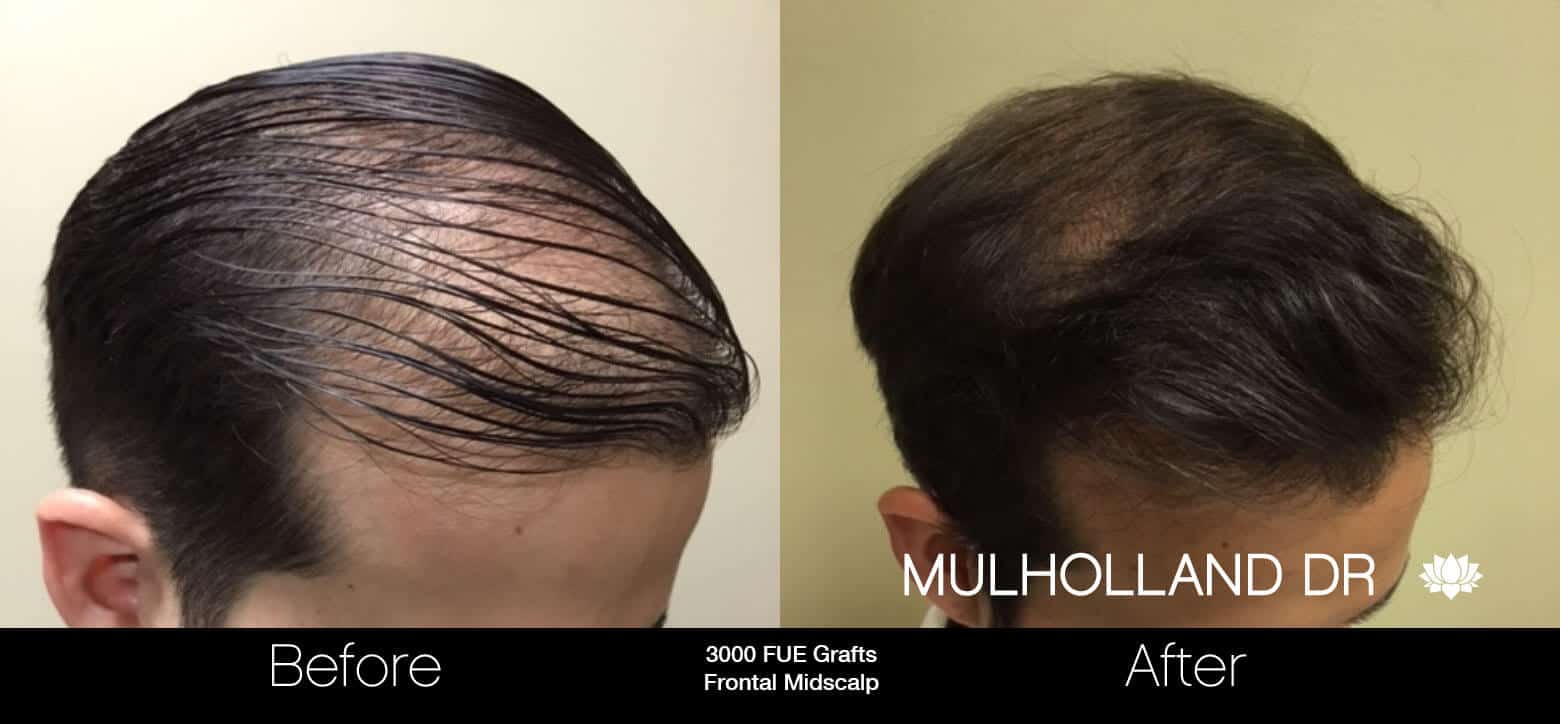 Artas Hair Transplant - Before and After Gallery - Patient Photo 30