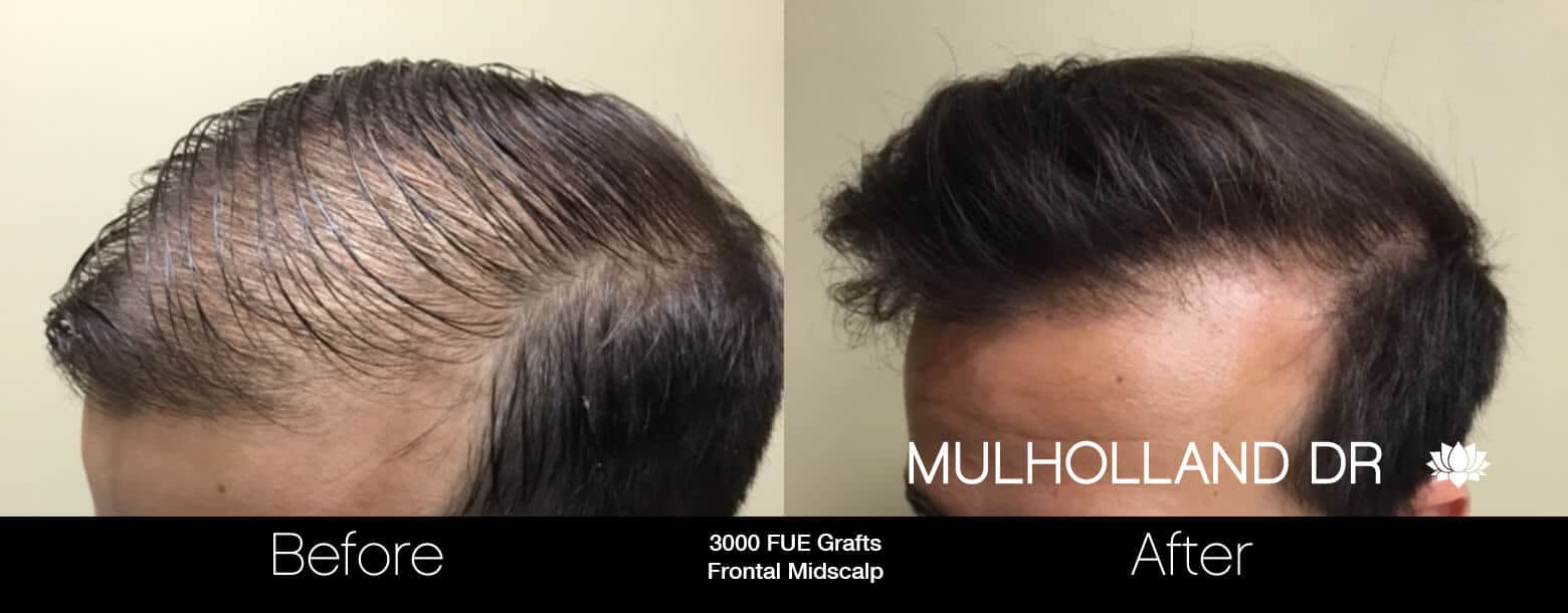 Artas Hair Transplant - Before and After Gallery - Patient Photo 31