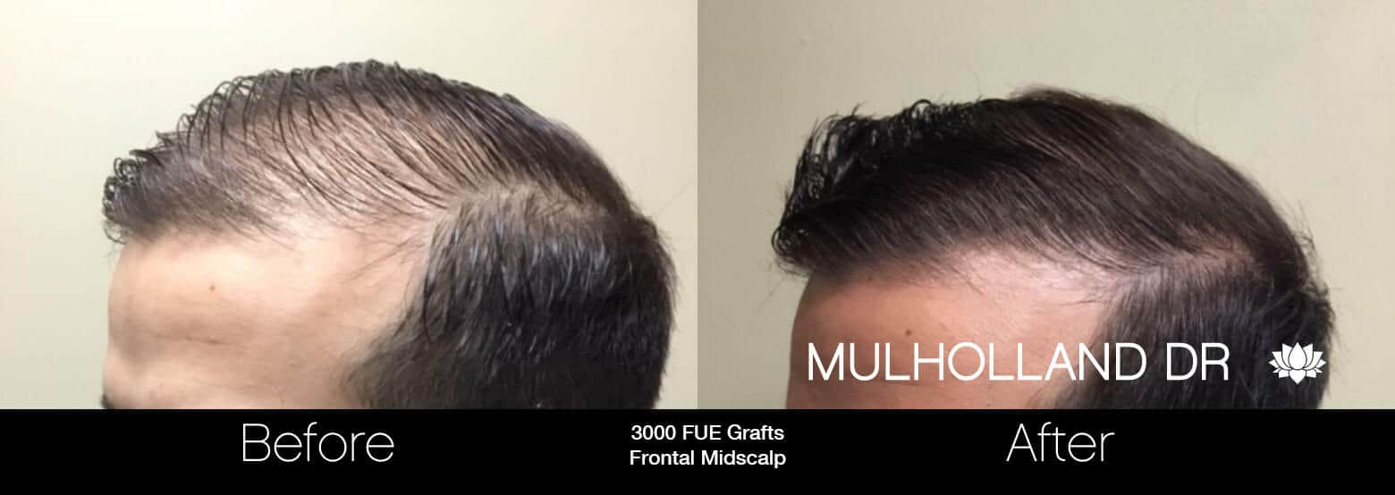Artas Hair Transplant - Before and After Gallery - Patient Photo 34