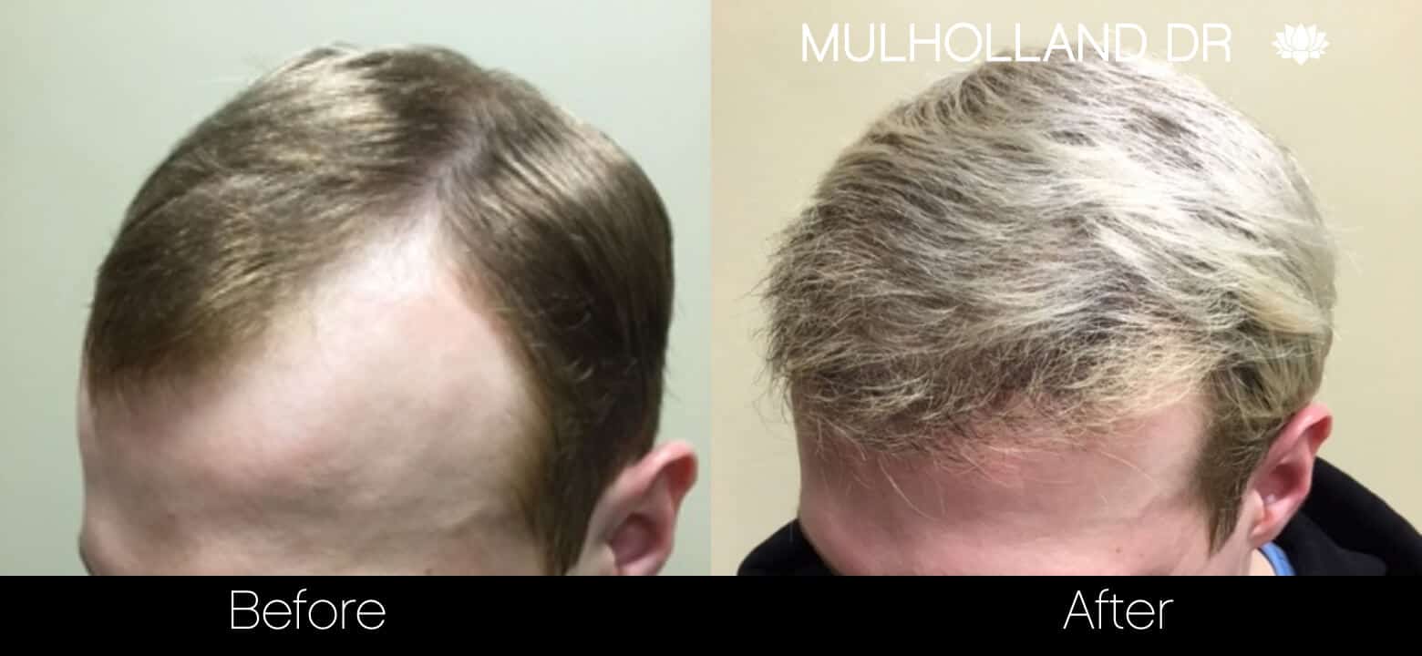 Artas Hair Transplant - Before and After Gallery - Patient Photo 36