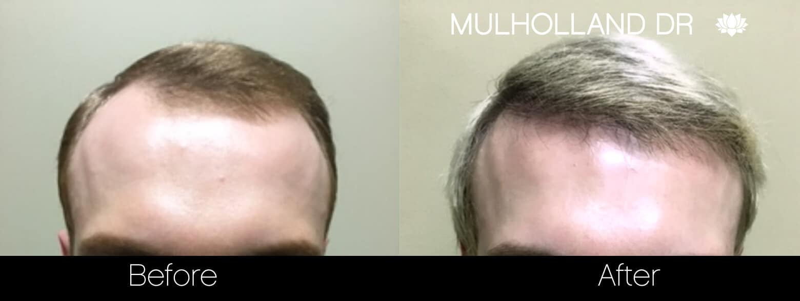 Artas Hair Transplant - Before and After Gallery - Patient Photo 37
