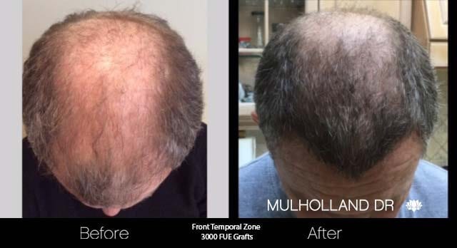 Artas Hair Transplant - Before and After Gallery - Patient Photo 39