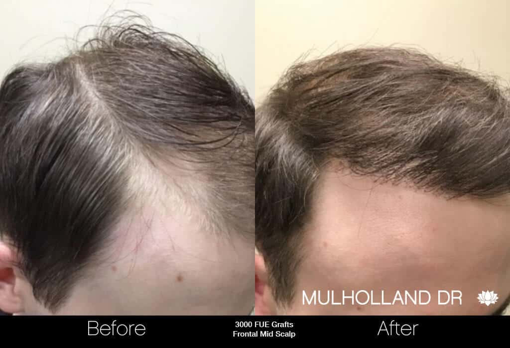 Artas Hair Transplant - Before and After Gallery - Patient Photo 4