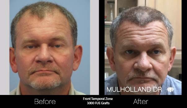 Artas Hair Transplant - Before and After Gallery - Patient Photo 40