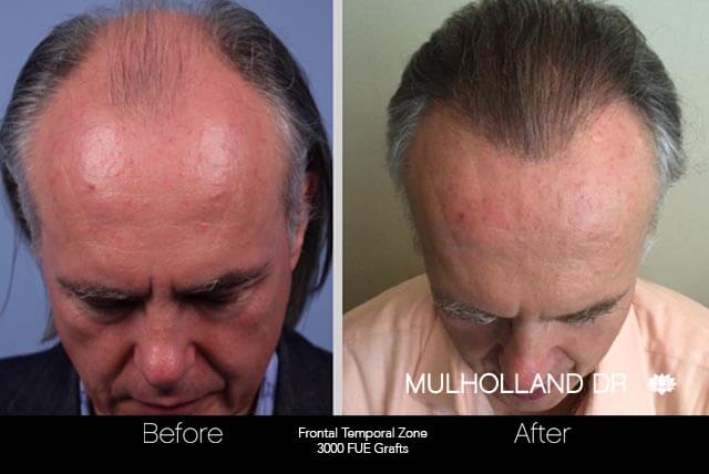 Artas Hair Transplant - Before and After Gallery - Patient Photo 41