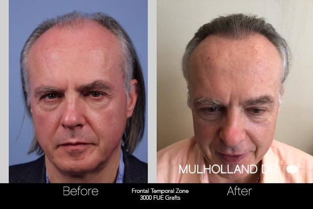 Artas Hair Transplant - Before and After Gallery - Patient Photo 42