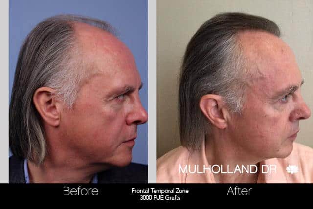 Artas Hair Transplant - Before and After Gallery - Patient Photo 43
